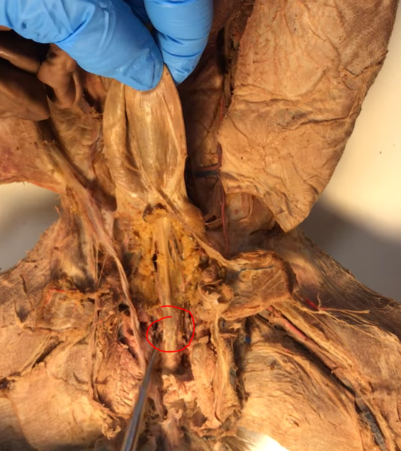 <p>What bump is felt here near the base of the urethra</p>