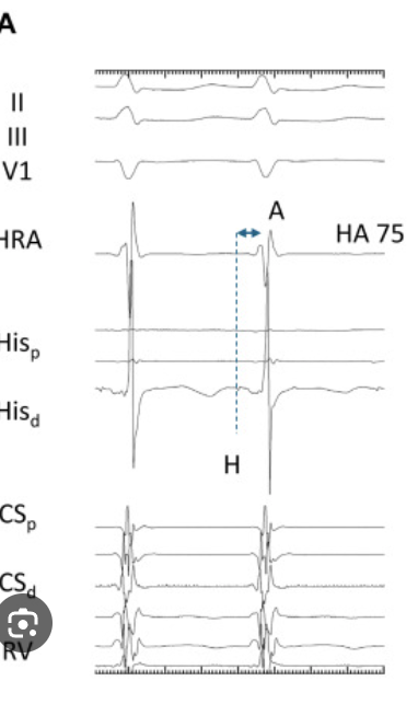 <p>Junctionals</p><ul><li><p>A and Vs happening at same time → overlapping </p></li></ul><p></p>