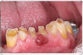 <p>Describe the base of this lesion.</p>
