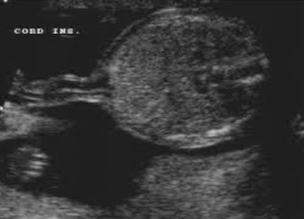 <ul><li><p>becomes belly button after born</p></li><li><p><span style="color: red;">umbilical cord seen entering fetal abdomen just above level of bladder</span></p></li><li><p>UV courses to liver within falciform ligament</p></li><li><p>UAs course on either side of bladder</p><ul><li><p>2VC can cause IUGR or is an indication of chromosomal abnormality</p></li></ul></li><li><p>SONO:</p><ul><li><p>image ACI with and without color Doppler</p></li><li><p><span style="color: red;">ensure smooth abdominal cord insertion (should be nothing “pooching” out)</span></p></li><li><p><span style="color: red;">rule out gastroschisis and omphalocele</span></p></li></ul></li></ul><p></p>