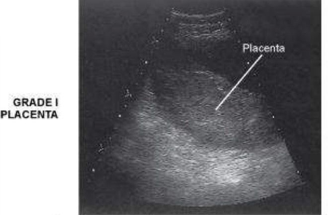 <p>Chorionic plate shows some subtle indentation; basal layer appears hypoechoic compared with placental substance; placenta exhibits a few scattered hyperechoic “calcifications”; normal changes at any time after 34 weeks of development</p>