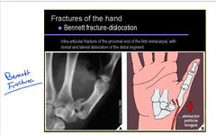 <p>Bennett fracture</p>