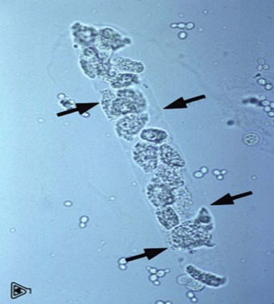 <ul><li><p>Contain WBC’s, predominately neutrophils.</p></li><li><p>Their presence indicate inflammation in the renal tubules or pyelonephritis.</p></li></ul><p></p>