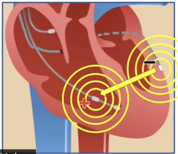 <ul><li><p>LV pacing vector only on LV lead: anodal stimulation not a problem</p></li><li><p><strong>Extended bipolar:</strong></p><ul><li><p>Anode on RV lead (ring or coil)</p></li><li><p>LV thresholds higher than RV thresholds</p></li><li><p>RV anodal threshold similar to LV cathodal threshold</p></li><li><p>Particularly likely with ring (CRT-P or dedicated bipolar CRT-D)</p></li></ul></li></ul><p></p>
