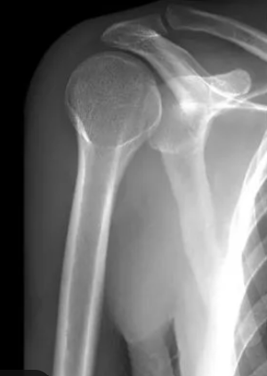 <p>The humeral head will move anterior to the scapula</p><p></p><p><strong>Test </strong>always involve a screening for associated fractures; Patient is positioned to have a flattened shoulder, arm in slight abduction/flexed elbow</p>