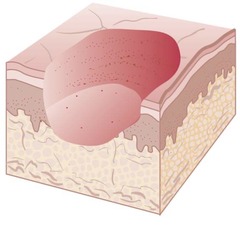 <p>Secondary lesion; an area of tissue loss involving the epidermis and often the dermis</p>