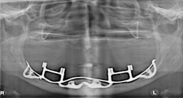 <p><span>Is surgically placed under the periosteum and rests on the bone</span></p><p><span>• Located </span><span style="color: rgb(255, 0, 0);">on or above the bone</span></p><p><span>• Most common in the mandible</span></p>