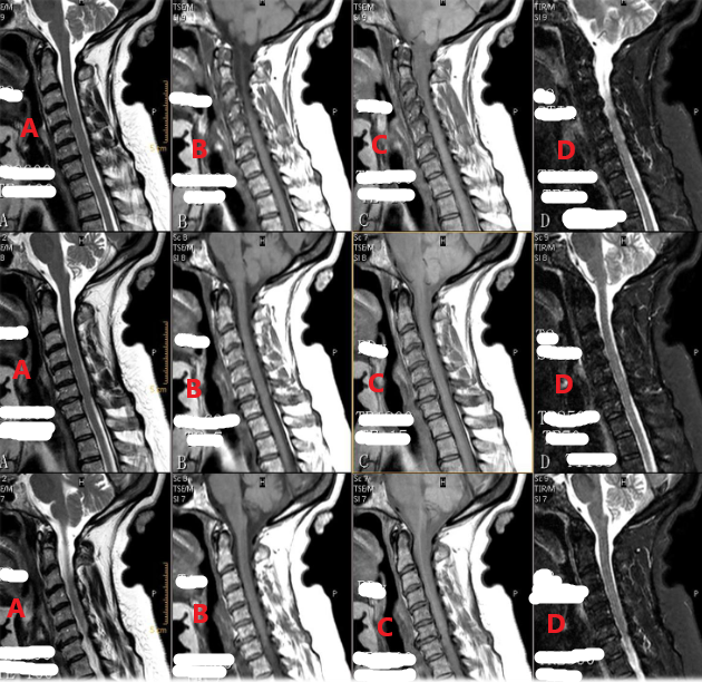 <p>Which row of these images is T2 weighted with fat signal suppressed ?</p>
