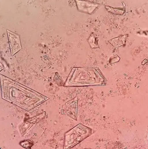 <p>Which pathogenic urinary crystals are seen in the shape of a parallelogram with notched corners?</p>