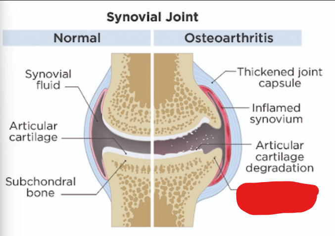 <p>what is it<strong> (Osteoarthritis)</strong></p>