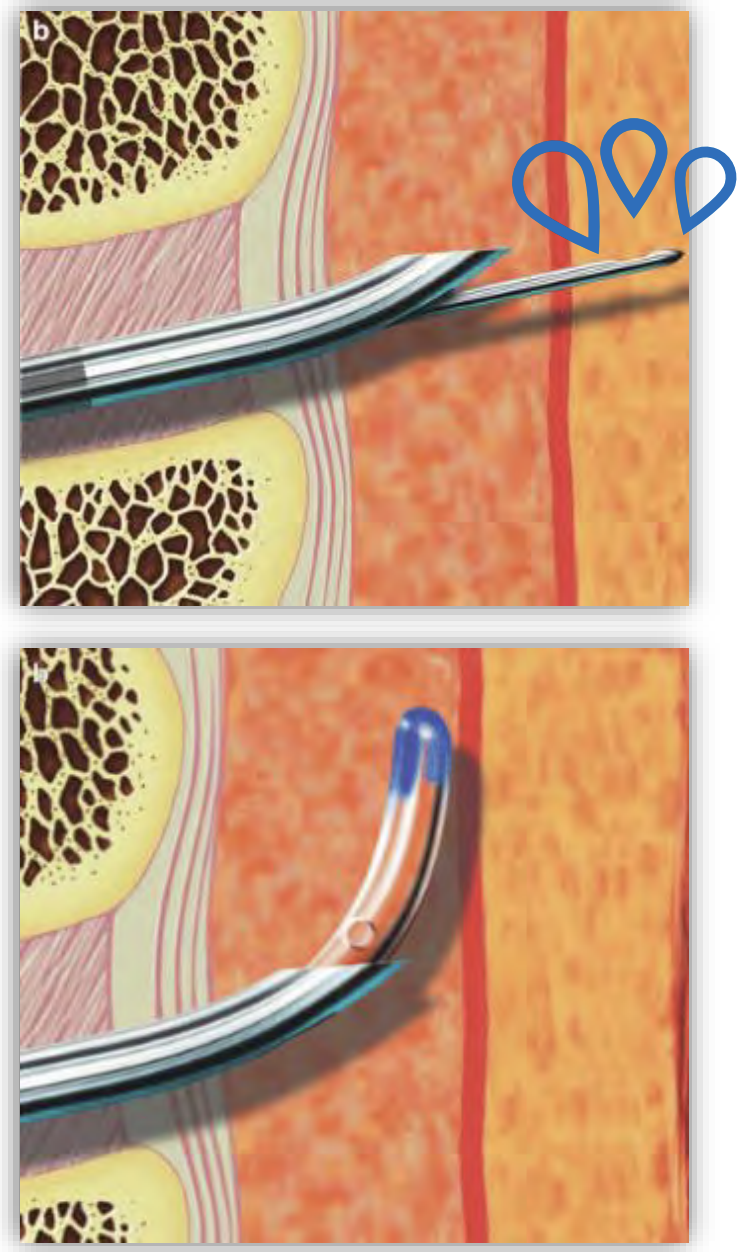 <p>Combined Spinal Epidural (CSE)</p>