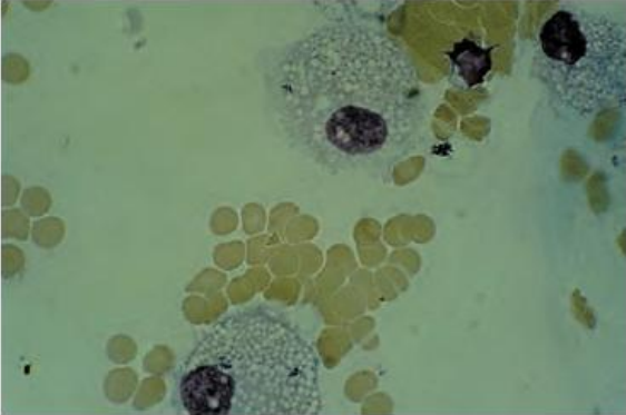<p><strong><u>Peritoneal Fluid Cells</u></strong></p><ul><li><p><span style="color: yellow;">Macrophages</span> containing <span style="color: yellow;">fat droplets</span>  </p></li></ul><p></p>