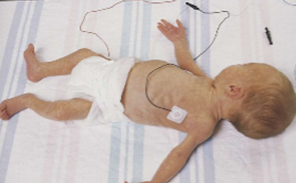 <ul><li><p>have immature flexor muscles, floppy </p></li></ul><p></p>