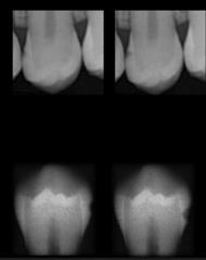 <p>irregular radiolucency with base at proximal surface near contact point</p>