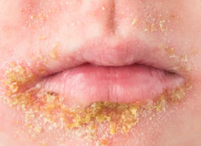 <p>not common in oral cavity due to the moist environment from saliva</p><p><span style="color: rgb(255, 0, 0);">if it </span>is removed, it leaves a bleeding surface and may form a pseudomembrane</p><p>dried pus, blood, dried serum, epithelial debris, and external matter  on skin or lips</p>