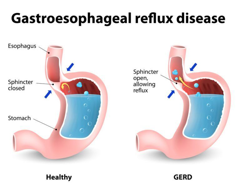 <p>GERD or gastroesophageal reflux disease is a _____ condition.</p>