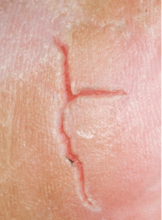 <p>Fissure (Fish-er)</p>