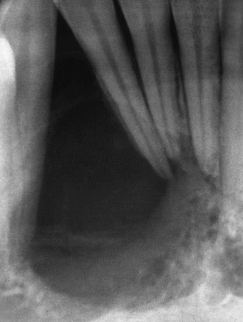 <p>can be seen in central giant cell granuloma</p>