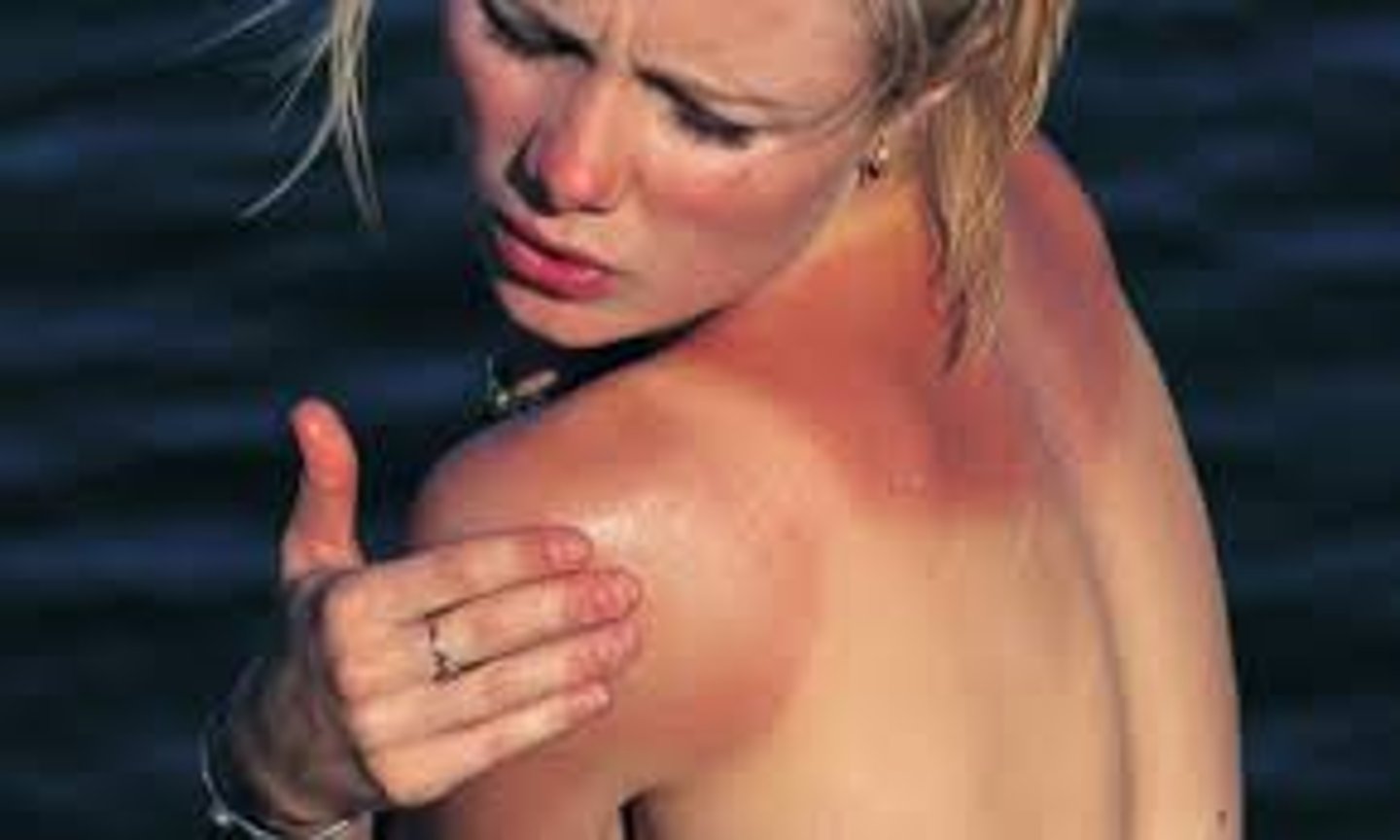 <p>prendre un coup de soleil</p>