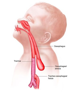 <p>A congenital defect in which the esophagus does not connect properly to the stomach, leading to feeding difficulties and aspiration risks. It often occurs with tracheoesophageal fistula. </p>