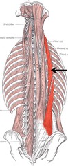 <p>O: Common origin</p><p>I: Lower 6 ribs, upper 6 ribs, transverse process of the lower cervical vertebrae</p><p>N: Spinal nerves</p><p>Fx: Extends and laterally flexes the spine</p><p>*Part of Erector Spinae</p>