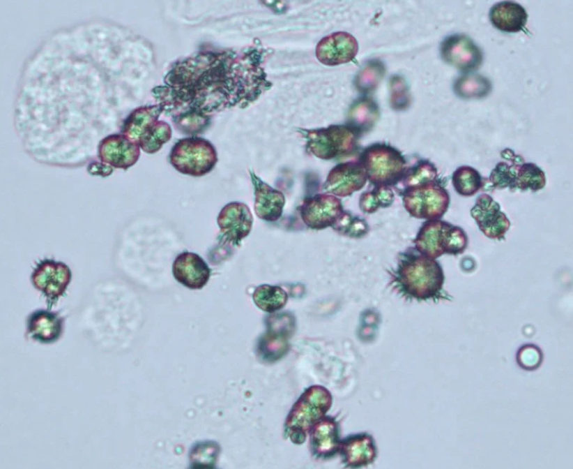 <p>The crystals appear round with spiky projections resembling “thorny apples”. What crystals are present? The pH is 8.0</p>