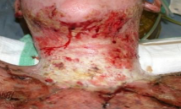 <p>3rd degree burn (full thickness) tx*</p>