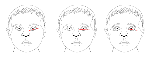 <p>First Palpebral folds then PERLA and finally EOM</p>