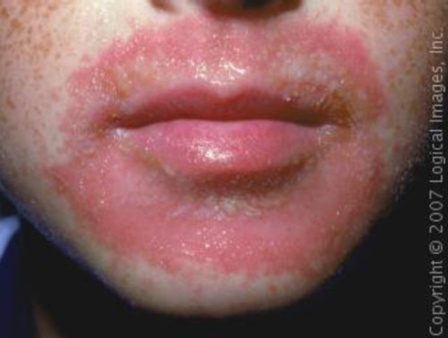 <p>occurs when irritating substances temporarily damage the epidermis</p>