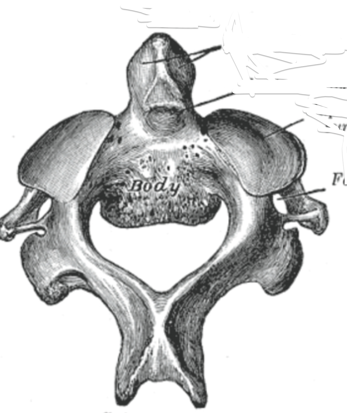 <p>Where is the dense/odontoid process, what vertebrae only has this  </p>