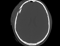 <p>- > 1cm depression of the inner table of the skull</p><p>- open depressed skull fx</p><p>- foreign body causing brain irritation</p>