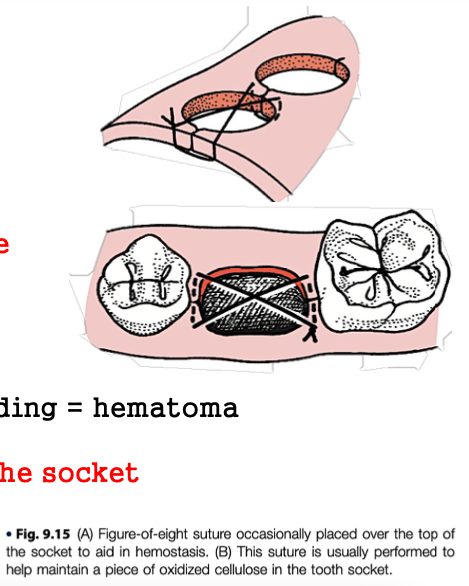 <p>this suture is usually performed to help maintain a piece of oxidized cellulose in the tooth socket and to aid in hemostasis</p>