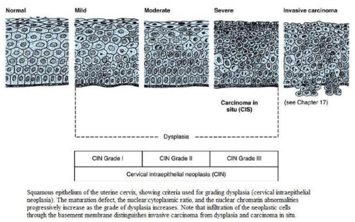 <p>• CIN 1- dysplasia is confined to the lower one-third of the epithelium. Regression is common. </p><p></p><p>• CIN 2- dysplasia involves the lower two-thirds of the epithelium. </p><p></p><p>• CIN 3- the full thickness of epithelium contains dysplastic cells. CIN3 has the highest risk of progression to cervical carcinoma. </p><p></p><p>• Cervical carcinoma- Neoplastic cells penetrate the basement membrane (invasion) and/or are found at a distant sites (metastasis); usually squamous cell carcinoma.</p>