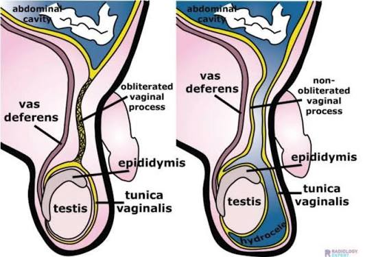 <p>INdirect = INfants</p><p>Often congenital (patent processus vaginalis) </p>