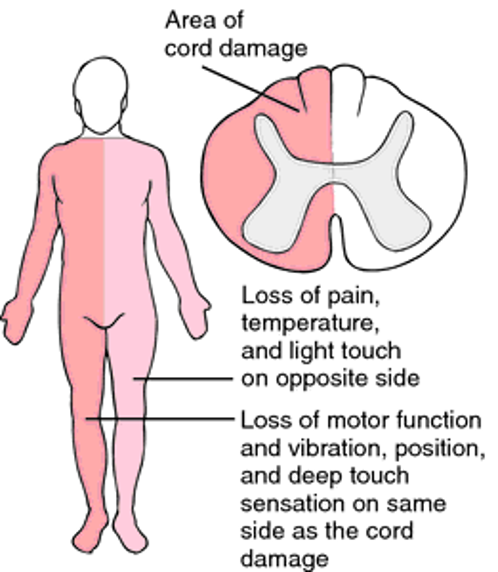<ul><li><p>Incomplete</p></li><li><p>Hemi section of cord</p></li><li><p>Ipsilateral paralysis</p></li><li><p>Ipsilateral superficial sensation, vibration, and proprioception loss</p></li><li><p>Contralateral loss of pain and temperature perception</p></li></ul><p></p>