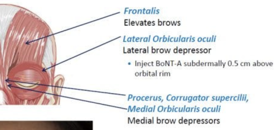 <p>Corrugator, orbicularis oculi, levator palpebrae superioris </p>