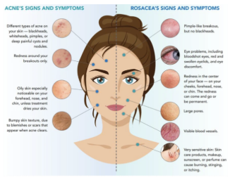 <p><span style="background-color: transparent;"><strong><u>Acne Rosacea</u></strong></span></p><ul><li><p><span style="background-color: transparent;">Pimple-like <strong>_____</strong>, but no <strong>_____</strong></span></p></li><li><p><span style="background-color: transparent;"><strong>_____</strong>, <strong>_____</strong>, and <strong>_____</strong> eyes/eyelids (<strong>vision problems</strong>)</span></p></li><li><p><span style="background-color: transparent;">Redness in <strong>_____</strong> (<strong><u>cheeks, forehead, nose, or chin</u></strong>)</span></p></li><li><p><span style="background-color: transparent;"><strong>_____</strong></span></p></li><li><p><span style="background-color: transparent;">Visible <strong>_____</strong></span></p></li><li><p><span style="background-color: transparent;">Very <strong>_____</strong></span></p></li></ul><p></p>