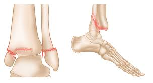 <p><mark data-color="#fcc9fc" style="background-color: rgb(252, 201, 252); color: inherit;">Rule out trimalleolar fracture.</mark></p>