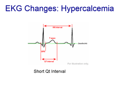 <p>short QT interval</p>