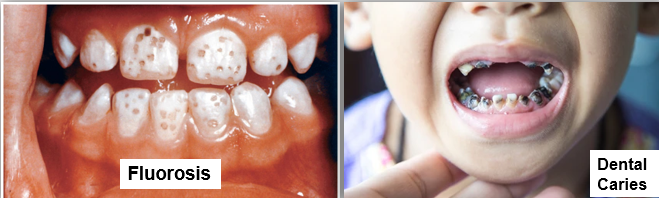 <ul><li><p><span style="font-family: "Arial (Body)";">Toxicity</span></p><ul><li><p><span style="font-family: "Arial (Body)";">Fluorosis in teeth and bones</span></p></li><li><p><span style="font-family: "Arial (Body)";">Condition caused by excess amounts of fluoride, resulting in mottling of the teeth</span></p></li></ul></li><li><p><span style="font-family: "Arial (Body)";">Deficiency</span></p><ul><li><p><span style="font-family: "Arial (Body)";">Increased susceptibility to dental caries</span></p></li></ul></li></ul><p></p>