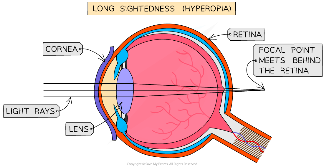 <ul><li><p>When the <strong>lens</strong> is the wrong shape and does not<strong> refract </strong>the light enough or the <strong>eyeball</strong> is too <strong>short</strong>.</p></li><li><p>The images of near objects are brought to focus <strong>behind </strong>the <strong>retina</strong>.</p></li></ul><p></p>