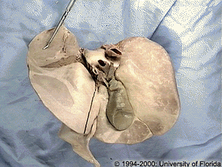 <p>what impression is being highlighted on the liver?</p>