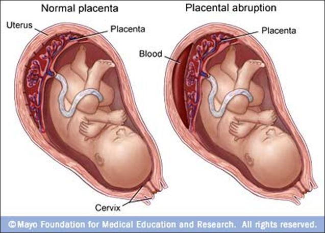 <ul><li><p>Obstetric emergency involving premature separation of placenta</p></li><li><p>At risk for no perfusion needs circulation</p></li><li><p><strong><u>Risk factors</u></strong></p><ul><li><p><span style="color: rgb(255, 74, 195);">Illicit drugs (cocaine)</span></p></li><li><p><span style="color: rgb(255, 74, 195);">Trauma</span></p><ul><li><p><span style="color: rgb(255, 74, 195);">IPV, CAR ACCIDENT</span></p></li></ul></li><li><p><span style="color: rgb(255, 74, 195);">HTN</span></p></li><li><p><span style="color: rgb(255, 74, 195);">Smoking</span></p></li></ul></li><li><p>Management dependent on <span style="color: yellow;">gestational age, extent of </span><span style="color: red;">hemorrhage, and maternal–fetal oxygenation perfusion</span></p><ul><li><p><span style="color: red;">Less than 20 wks SAB</span></p></li></ul></li><li><p>Maintenance of maternal cardiovascular status</p></li><li><p>Prompt delivery of fetus</p></li><li><p>Cesarean birth if fetus still alive; vaginal birth if fetal demise</p></li></ul><ul><li><p><strong><u>S/S:</u></strong></p><ul><li><p><span style="color: yellow;">Vaginal bleeding (but also may not see any)</span></p></li><li><p><span style="color: yellow;">Hypertonic contractions</span></p></li><li><p><span style="color: yellow;">Maternal hypovolemia (shock, oliguria, anuria)</span></p><ul><li><p><span style="color: yellow;">Coagulopathy</span></p></li></ul></li><li><p><span style="color: yellow;">Pain mild to severe – usually localized over one region, but could be diffuse and feel like a board</span></p></li><li><p><span style="color: yellow;">“Silent Abruption” – may not have any pain or tenderness</span></p><ul><li><p><span style="color: yellow;">Still see other signs</span></p></li></ul></li><li><p><span style="color: yellow;"><strong>Maternal risk:</strong> hemostasis related</span></p></li><li><p><span style="color: yellow;">Perinatal mortality/Neonatal mortality and morbidity is 15-30% - because of:</span></p><ul><li><p><span style="color: yellow;">Hypoxia, preterm birth, SGA</span></p></li><li><p><span style="color: yellow;">Risk of neuro defects is increased</span></p></li></ul></li></ul></li></ul><p></p>