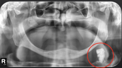 <p>How is this lesion described in terms of internal structure?</p>