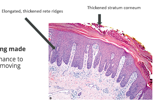 <ul><li><p><span style="color: red;">Rapid epidermal cell turnover</span>→ Marked epidermal thickening of the stratum corneum (<span style="color: red;"><strong>Hyperkeratosis</strong></span><strong>-</strong> skin producing cells faster than it can shed them)</p></li><li><p><span style="color: red;"><strong>Rete ridges</strong></span><strong> </strong>are significantly and evenly <strong>elongated</strong></p></li><li><p>Cornified layer exhibits <span style="color: red;">(<strong>Parakeratosis</strong></span><strong>-</strong> immaturity of those piled-up cells<strong>)</strong></p></li><li><p>Accumulation of acute inflammatory cells (neutrophils) within the epidermis</p></li></ul><p></p>