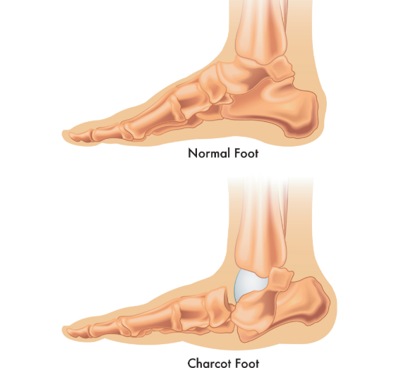 <p>a type of diabetic foot deformity with any abnormalities, often including a hallux valgus (turning inward of the great toe). </p><p>Walking collapses the arch, shortens the foot, and gives the foot a “rocker bottom” shape.</p>