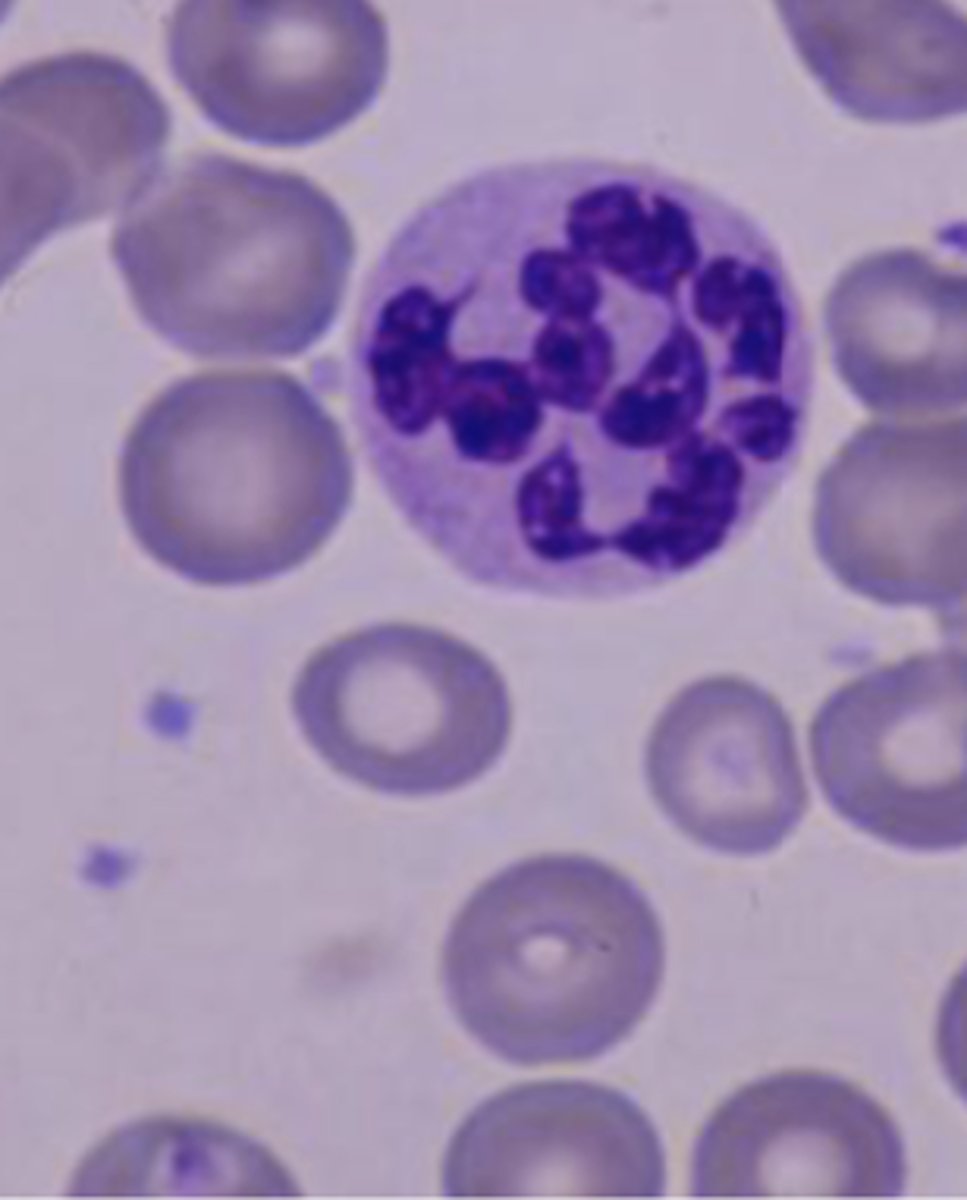 <p>Neutrophils with > 5 lobes</p>