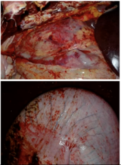 <p>1. Sudden death, high fever (40.5-42℃), haemorrhage, bleeding from orifices, petechiae on MM, bacteraemia from secondary infections due to leukopenia</p><p>2. History of access to broken fern, CS, PM findings, prolonged bleeding + clotting times, loss of condition, anorexia</p><p>3. Haemorrhage in all tissues, red/yellow bacterial infarcts in liver/heart/kidney, ulceration of intestines with severe inflammation</p>