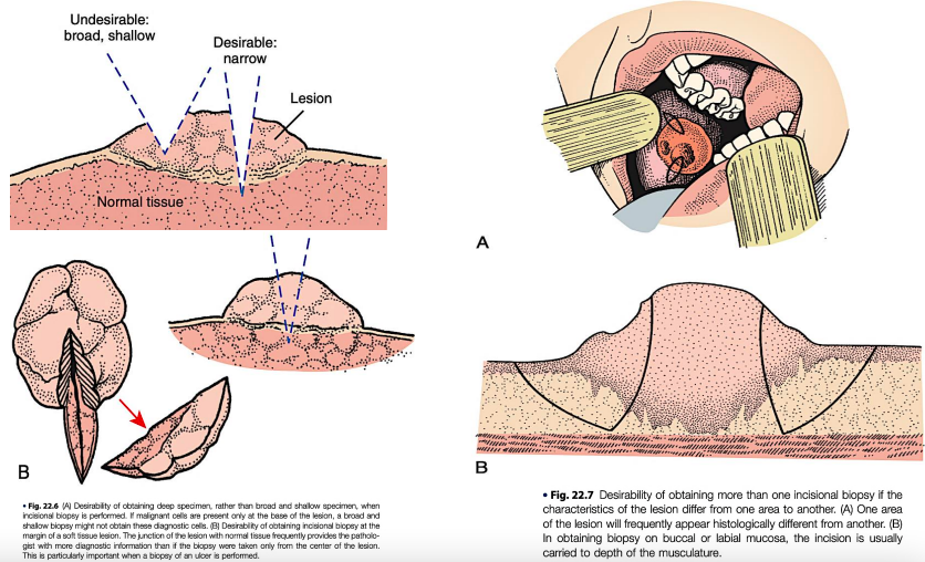 <p>a biopsy that samples only a particular or representative part of the lesion</p><ul><li><p><strong>indications:</strong></p><ul><li><p><span style="color: red;">hazardous location</span></p></li><li><p><span style="color: red;">if there is a suspicion of malignancy</span></p></li><li><p><span style="color: red;">large lesions ( >1cm in diameter)</span></p></li></ul></li><li><p><strong>procedure:</strong></p><ul><li><p>usually a <span style="color: red;">wedge-shaped piece</span> is removed</p></li><li><p>a narrow and deep specimen is better than a broad and shallow specimen.</p></li><li><p>the biopsy site should be selected in an area that shows complete tissue changes</p></li><li><p>the material should be taken from the <span style="color: red;">edge of the lesion</span> to include some normal tissue</p></li></ul></li></ul><p><em>[a negative report of a highly suspicious oral lesion suggests that another biopsy specimen is necessary in view of the clinical impressions]</em></p>