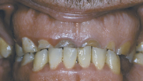 <p>tooth-tooth </p>